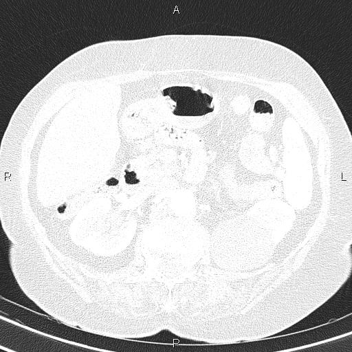 Abdominal aortic aneurysm (Radiopaedia 85063-100606 Axial lung window 71).jpg