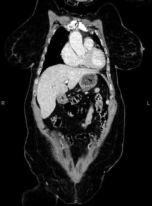 Abdominal aortic aneurysm (Radiopaedia 85063-100606 Coronal C+ arterial phase 10).jpg