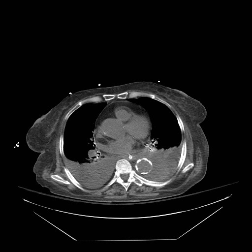 Abdominal aortic aneurysm - impending rupture (Radiopaedia 19233-19247 Axial non-contrast 8).jpg
