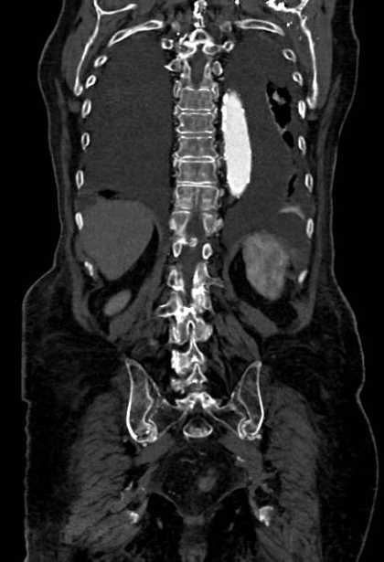 Abdominal aortic aneurysm with thrombus fissuration (Radiopaedia 73192-83919 Coronal C+ arterial phase 73).jpg