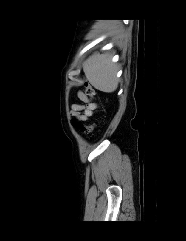 Abdominal lymphoma - with sandwich sign (Radiopaedia 53486-59492 Sagittal C+ portal venous phase 5).jpg