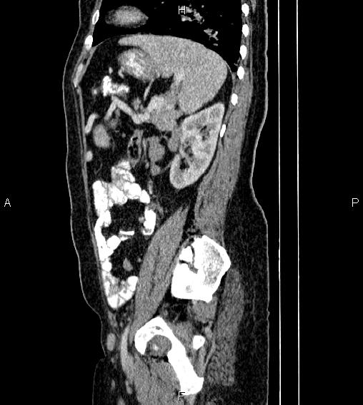 Abdominal lymphoma with sandwich sign (Radiopaedia 84378-99704 Sagittal C+ portal venous phase 68).jpg
