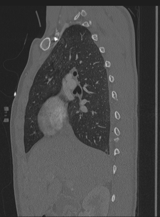 Abdominal multi-trauma - devascularised kidney and liver, spleen and pancreatic lacerations (Radiopaedia 34984-36486 Sagittal bone window 56).png