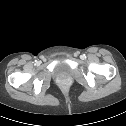 File:Abdominal tuberculosis and appendicitis (Radiopaedia 65631-74735 Axial C+ portal venous phase 70).png