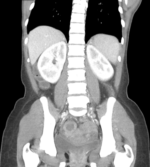 File:Abdominal tuberculosis and appendicitis (Radiopaedia 65631-74735 Coronal C+ portal venous phase 33).png
