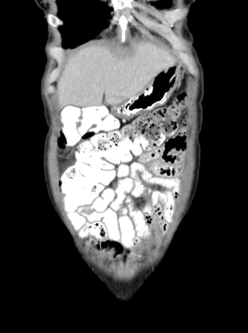 Abdominal wall and retroperitoneal tuberculosis (Radiopaedia 88137-104729 Coronal C+ portal venous phase 19).jpg
