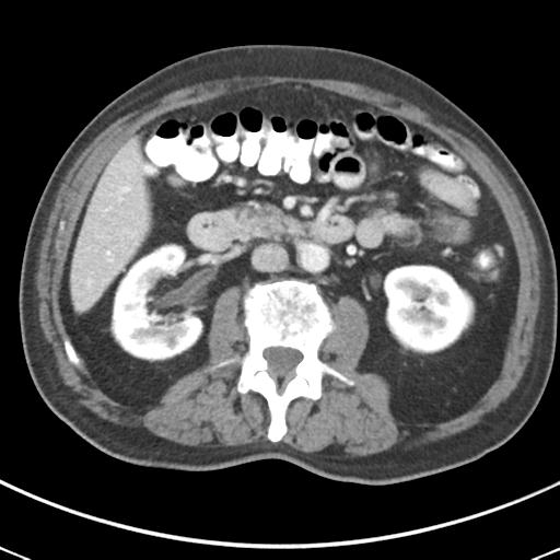 Abdominal wall metastasis from colorectal carcinoma (Radiopaedia 31016-31717 Axial C+ portal venous phase 34).jpg