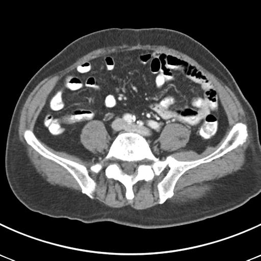 Abdominal wall metastasis from colorectal carcinoma (Radiopaedia 31016-31717 Axial C+ portal venous phase 50).jpg