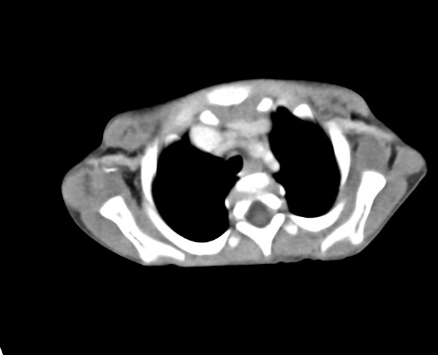 Abdominopelvic rhabdomyosarcoma (Radiopaedia 78356-90984 Axial C+ portal venous phase 6).jpg