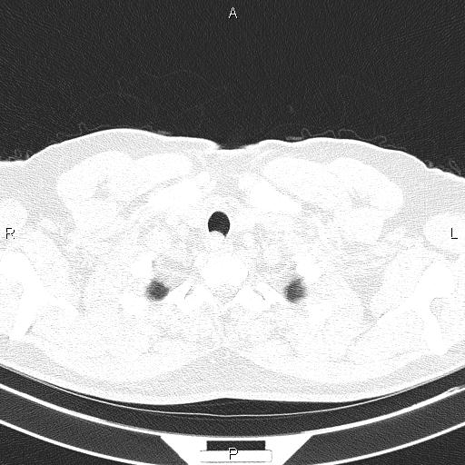 Aberrant right subclavian artery (Radiopaedia 87093-103354 Axial lung window 8).jpg
