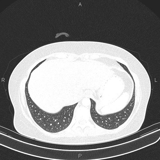 Aberrant right subclavian artery (Radiopaedia 87334-103629 Axial lung window 56).jpg