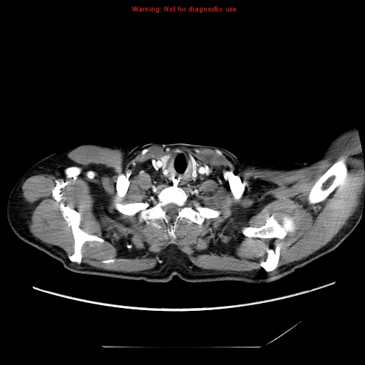 File:Aberrant right subclavian artery (Radiopaedia 9379-10071 Axial C+ arterial phase 2).jpg