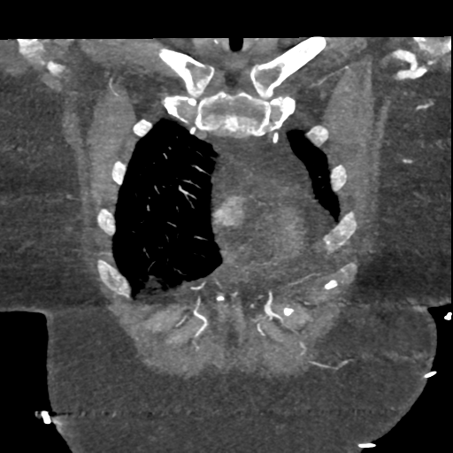 File:Aberrant right subclavian artery with Kommerell diverticulum (Radiopaedia 47982-52769 Coronal C+ arterial phase 13).png