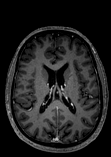 Accessory middle cerebral artery (Radiopaedia 73114-83828 Axial T1 C+ 1).jpg