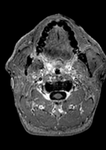 Accessory middle cerebral artery (Radiopaedia 73114-83828 Axial T1 C+ 240).jpg