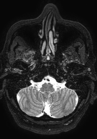 Accessory middle cerebral artery (Radiopaedia 73114-83828 Axial T2 190).jpg
