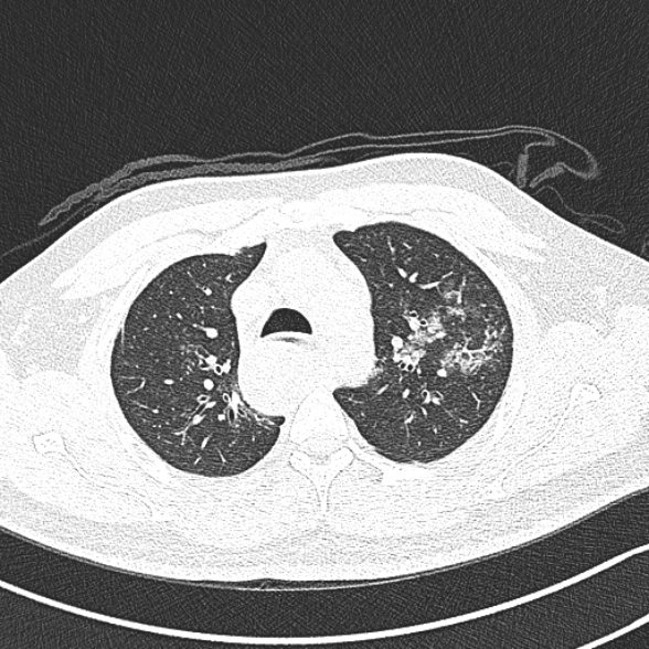 Achalasia with aspiration (Radiopaedia 55413-61845 Axial lung window 19).jpg