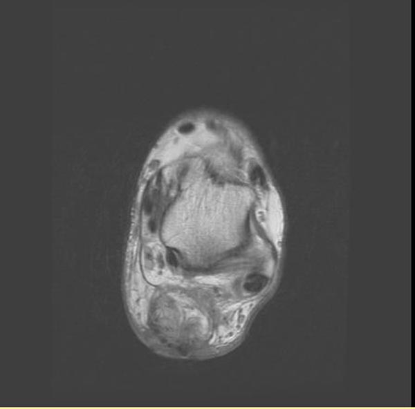 File:Achilles tendon rupture (Radiopaedia 11159-11524 E 1).jpg