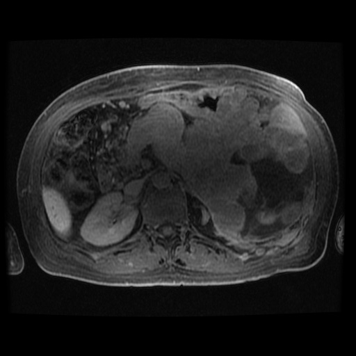 Acinar cell carcinoma of the pancreas (Radiopaedia 75442-86668 Axial late phase (~30 mins) 53).jpg