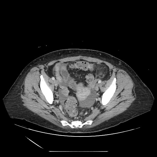 Acinar cell carcinoma of the pancreas (Radiopaedia 75442-86669 Axial C+ portal venous phase 124).jpg