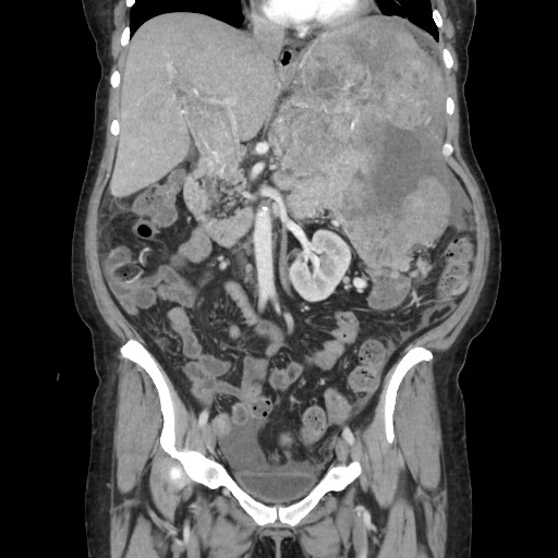 Acinar cell carcinoma of the pancreas (Radiopaedia 75442-86669 Coronal C+ portal venous phase 59).jpg