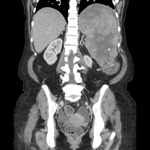 Acinar cell carcinoma of the pancreas (Radiopaedia 75442-86669 Coronal C+ portal venous phase 87).jpg