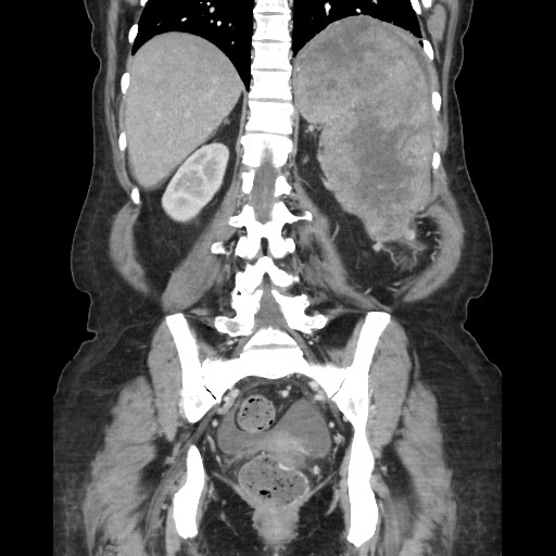 File:Acinar cell carcinoma of the pancreas (Radiopaedia 75442-86669 Coronal C+ portal venous phase 91).jpg