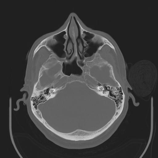 File:Acoustic schwannoma (Radiopaedia 29488-29982 AXIAL BONE THICK non-contrast 12).jpg
