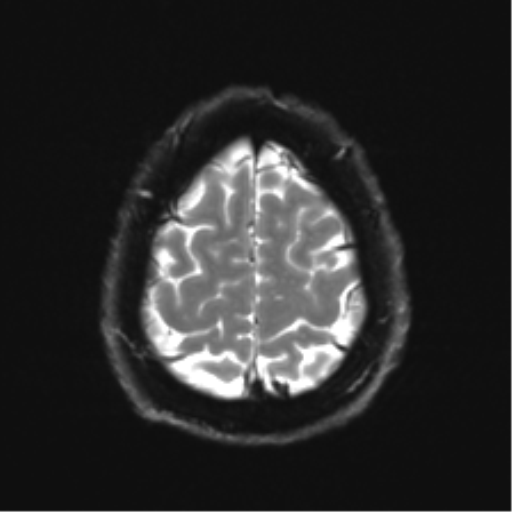 File:Acoustic schwannoma (Radiopaedia 50846-56358 Axial DWI 26).png