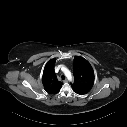 Acromioclavicular joint cyst (Radiopaedia 58455-65610 Axial C+ arterial phase 37).jpg