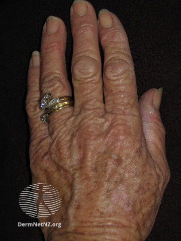 File:Actinic keratoses affecting the hands (DermNet NZ lesions-ak-hands-242).jpg