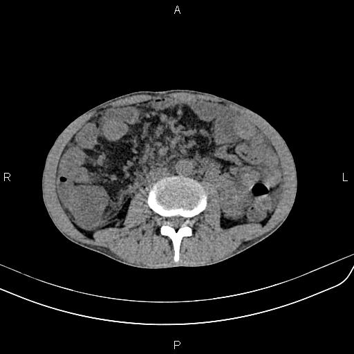Active crohn disease (Radiopaedia 87133-103397 Axial non-contrast 53).jpg