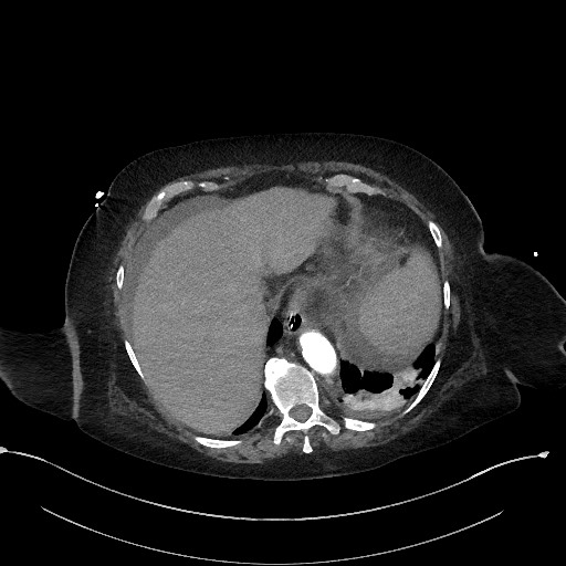 Active renal extravasation with large subcapsular and retroperitoneal hemorrhage (Radiopaedia 60975-68796 Axial C+ arterial phase 33).jpg
