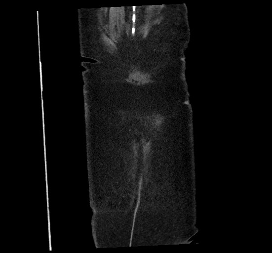Active renal extravasation with large subcapsular and retroperitoneal hemorrhage (Radiopaedia 60975-68796 Coronal C+ portal venous phase 146).jpg