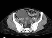 Acute Budd-Chiari syndrome (Radiopaedia 60858-68638 A 241).jpg