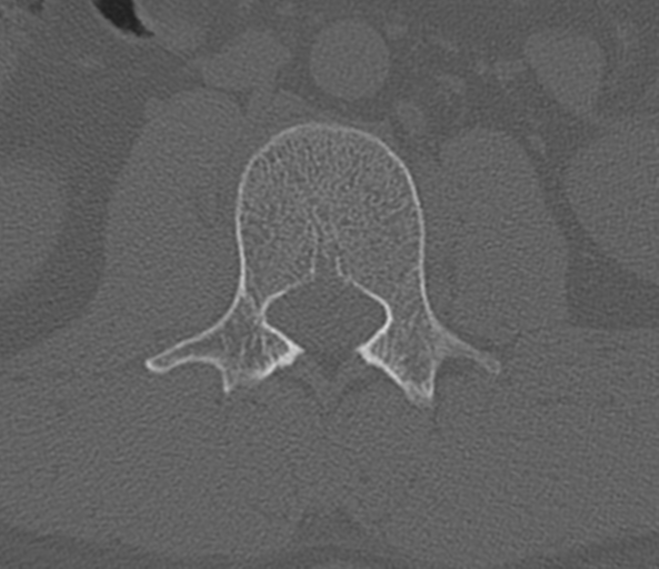 File:Acute L1 burst compression fracture (Radiopaedia 34430-35755 Axial bone window 34).png