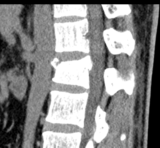 File:Acute L1 burst compression fracture (Radiopaedia 34430-35755 E 47).png
