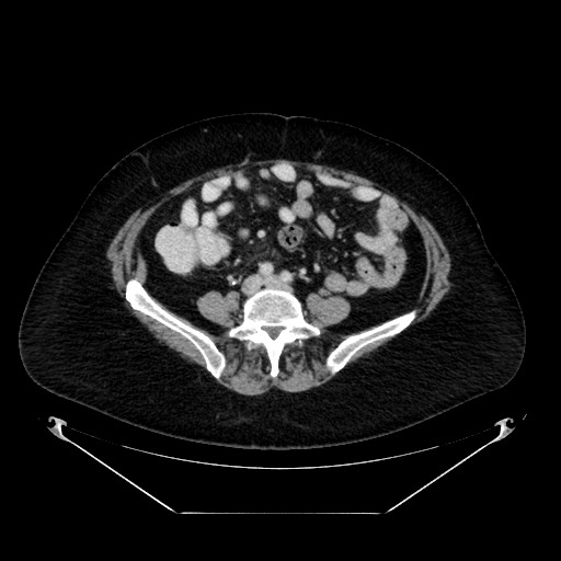 Acute appendicitis, heterotaxy syndrome (Radiopaedia 66884-76202 Axial C+ portal venous phase 83).jpg
