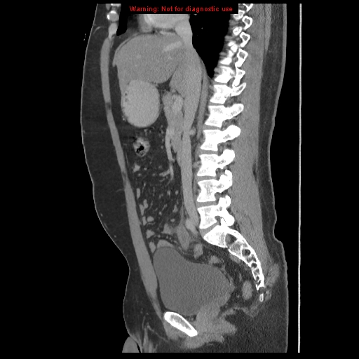 File:Acute appendicitis (Radiopaedia 10498-10973 Sagittal C+ portal venous phase 25).jpg