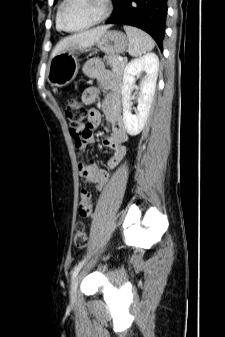 Acute appendicitis (Radiopaedia 22892-22918 Sagittal C+ portal venous phase 62).png