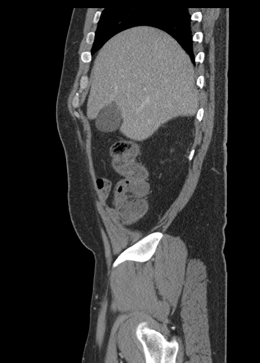 Acute appendicitis (Radiopaedia 48511-53463 Sagittal C+ portal venous phase 34).jpg