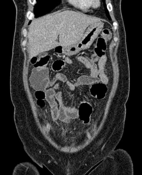 File:Acute appendicitis (Radiopaedia 48792-53822 Coronal C+ portal venous phase 70).jpg