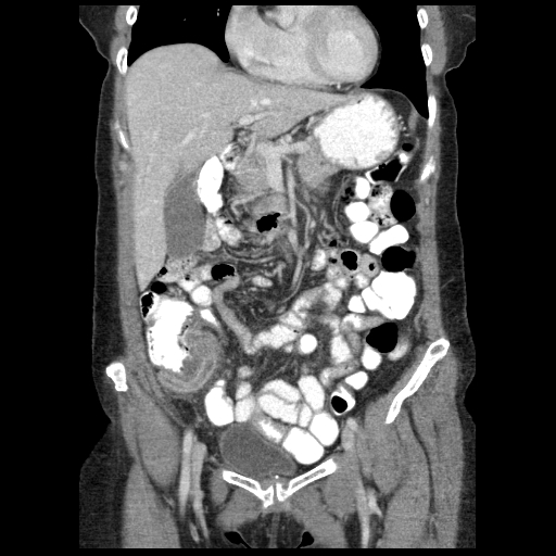 Acute appendicitis (Radiopaedia 52672-58589 Coronal C+ portal venous phase 26).jpg