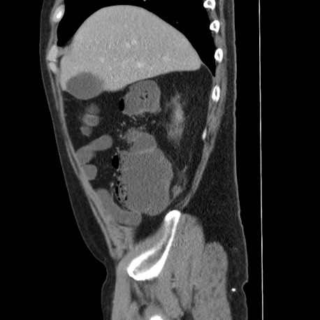 Acute appendicitis (Radiopaedia 66513-75790 Sagittal C+ portal venous phase 29).jpg