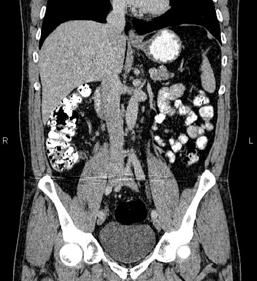 Acute appendicitis (Radiopaedia 84780-100240 Coronal C+ portal venous phase 41).jpg