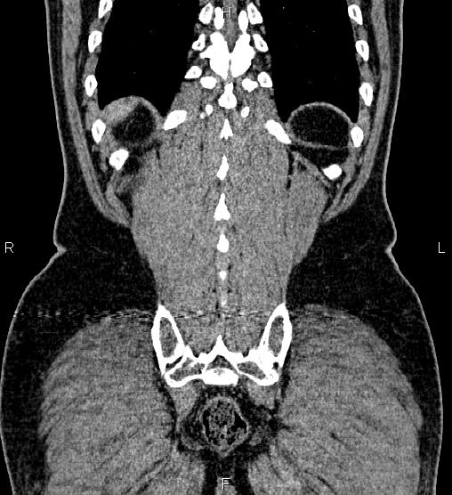 Acute appendicitis (Radiopaedia 84780-100240 Coronal C+ portal venous phase 73).jpg