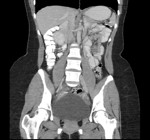 File:Acute appendicitis (Radiopaedia 9417-10099 Coronal C+ portal venous phase 4).jpg