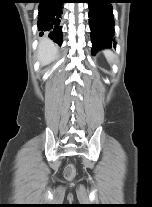 Acute cholecystitis (Radiopaedia 29814-30327 Coronal C+ portal venous phase 43).jpg