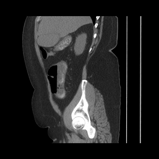 File:Acute cholecystitis with tensile fundus sign (Radiopaedia 71394-81723 Sagittal non-contrast 57).jpg