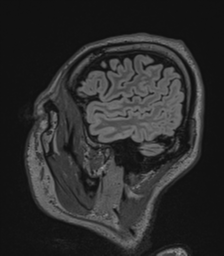 Acute disseminated encephalomyelitis (ADEM)- Anti-NMDA receptor encephalitis (Radiopaedia 54920-61201 Sagittal FLAIR 69).png